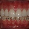Rehabilitacion Oral- Estetica Dental - Dise�o de Sonrrisa