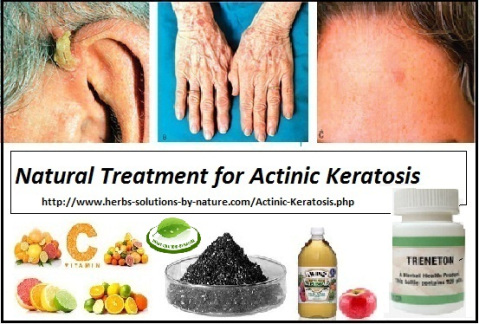 Treneton, Herbal Treatment for Actinic Keratosis